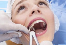 Removal of Impacted Teeth